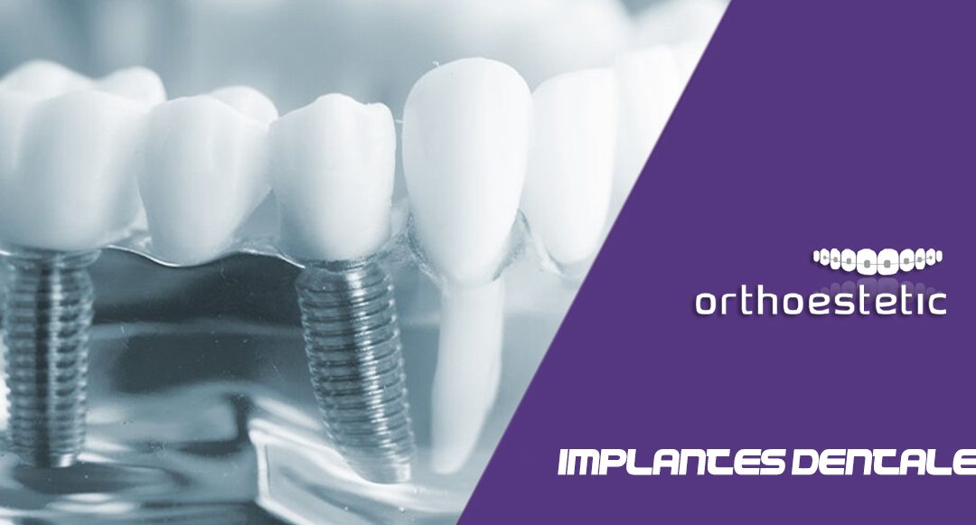 Implantes dentales