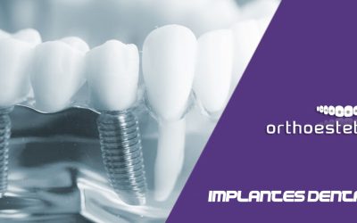 Implantes dentales